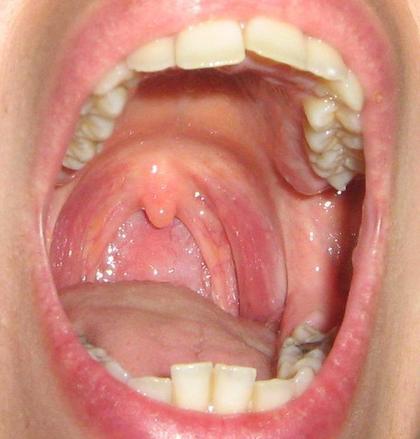 喉咙正常图片