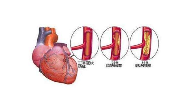 心脏大是什么病严重吗