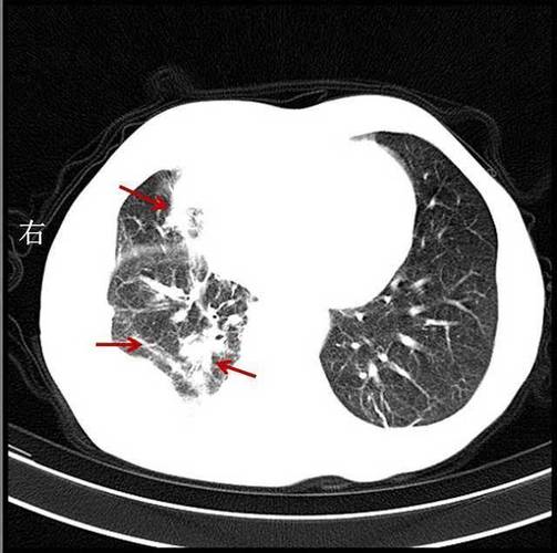 肺部钙化灶是什么意思