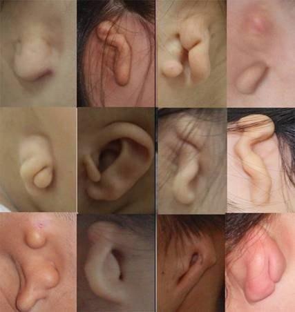 先天性小耳畸形的相关图片