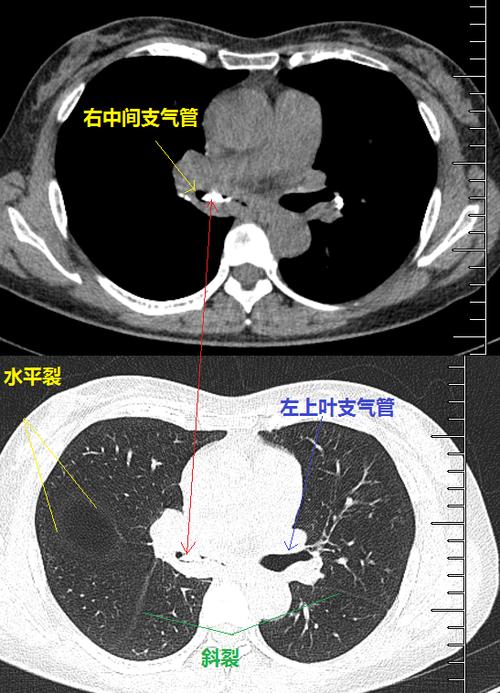 肺部钙化灶是什么意思的相关图片